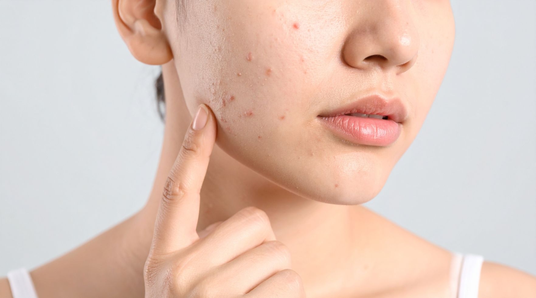 Trądzik u dorosłych – przyczyny powstawania i sposoby leczenia